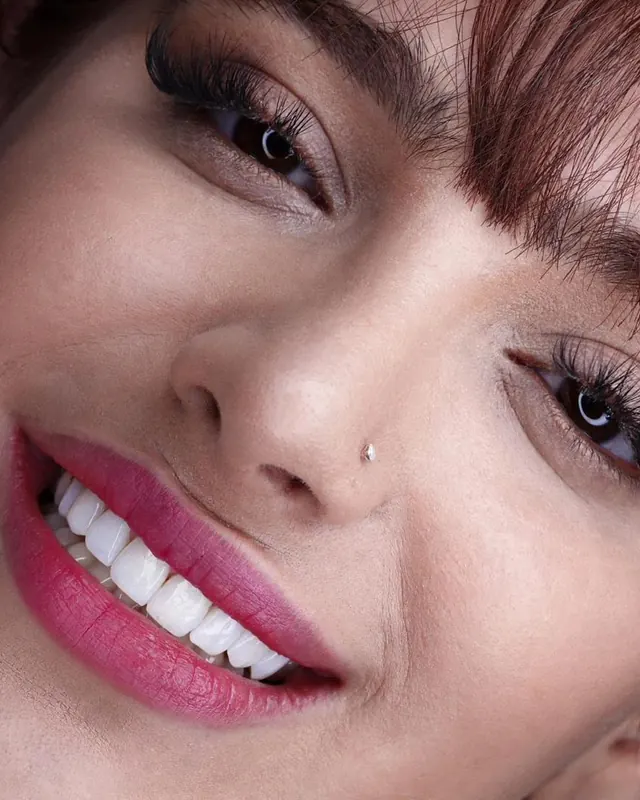 Smile result by Dr. Leila Sahabi, cosmetic dentist in Dubai