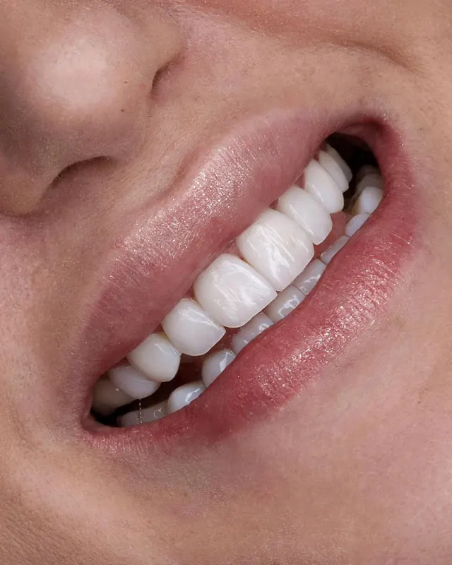 Smile result by Dr. Leila Sahabi, cosmetic dentist in Dubai